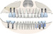 Colapso oclusal posterior por extrusión dentaria Reconstrucción con implantes simultáneos con elevación de seno y ROG