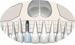 Implante e injerto conectivo subepitelial para incisivo lateral