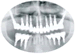 Edentulismo maxilar completo con implantes pterigoideos