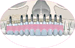 Reconstrucción maxilar con injerto de cadera en onlay + sinus