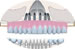 Atrofia maxilar. Reconstrucción con implantes inclinados y prótesis fija ceramometálica sobre mesoestructura de titanio