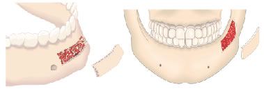 Injertos corticales