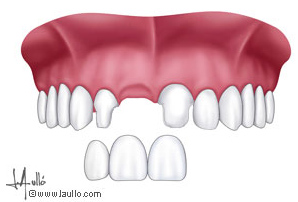 Incisivo lateral ausente sustituido por un puente de tres dientes