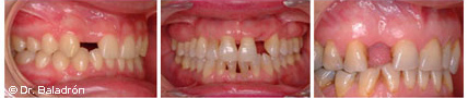 Pacientes que han perdido un diente en el maxilar superior