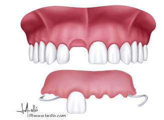 Prótesis removible fabricada de metal, acrílico y dientes de resina.