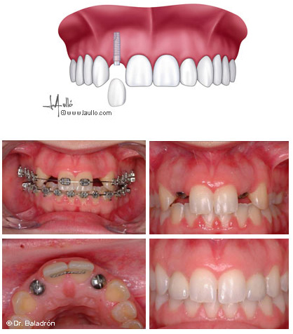 Diente provisional - DIENTES POSTIZOS PROVISIONALES