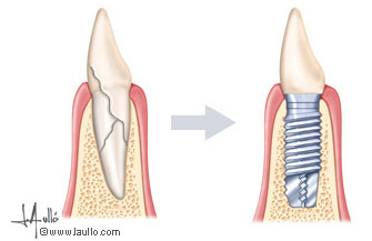 Implantes de Titanio