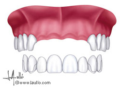 Incisivos ausentes sustituido por un puente de ocho dientes