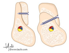 injertos corticales con tornillos de titanio