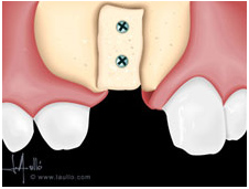 Injertos corticales