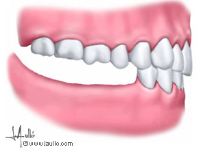 Paciente que ha perdido varios dientes posteriores en la mandíbula