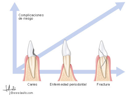 Causas de la pérdida del hueso del diente