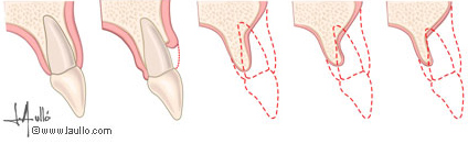 Pérdida progresiva del hueso donde estaba alojada la raíz del diente