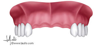 Pérdidad de varios dientes