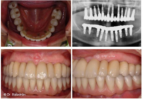 Manual Pakistán Vientre taiko Clínica Baladrón: Pérdida de TODOS los dientes en el maxilar inferior  (mandíbula). Alternativas de tratamiento.