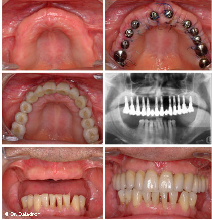 Chirrido cargando Fracción Clínica Baladrón: Pérdida de TODOS los dientes en el maxilar superior.  Alternativas de tratamiento.