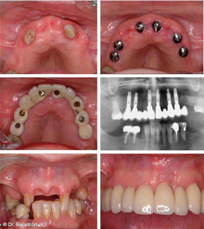 Modales Melancolía aerolíneas Clínica Baladrón: Pérdida de TODOS los dientes en el maxilar superior.  Alternativas de tratamiento.