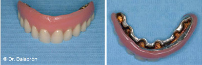 Modales Melancolía aerolíneas Clínica Baladrón: Pérdida de TODOS los dientes en el maxilar superior.  Alternativas de tratamiento.