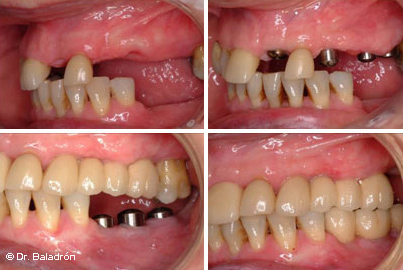 Prótesis parciales fijas sobre implantes colocados en el maxilar y la mandíbula