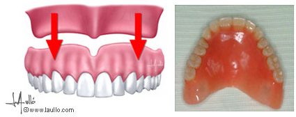 Modales Melancolía aerolíneas Clínica Baladrón: Pérdida de TODOS los dientes en el maxilar superior.  Alternativas de tratamiento.