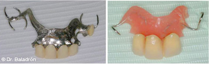 prótesis removibles, de metal y de resina