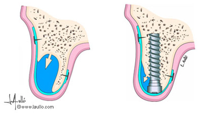 Reconstrucción del hueso simultáneamente con la colocación del implante.