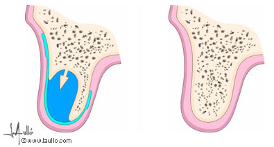 Regeneración ósea guiada mediante una membrana de Gore-tex y un injerto óseo.
