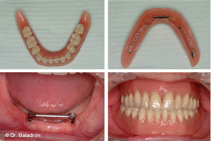 Sobredentadura mandibular sobre 2 implantes unidos con una barra