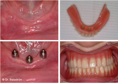 Sobredentadura mandibular sobre 3 implantes con un mecanismo de retención de bola