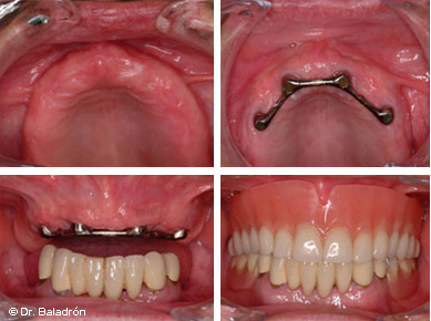 Sobredentadura sobre 4 implantes