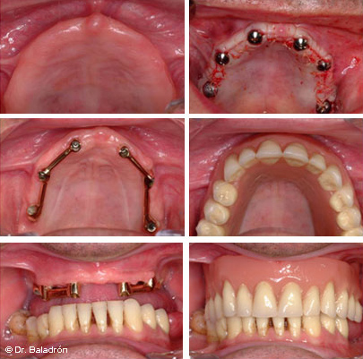 Sobredentadura sobre 6 implantes