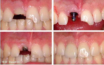 La parte superior de los dientes postizos aislado sobre fondo