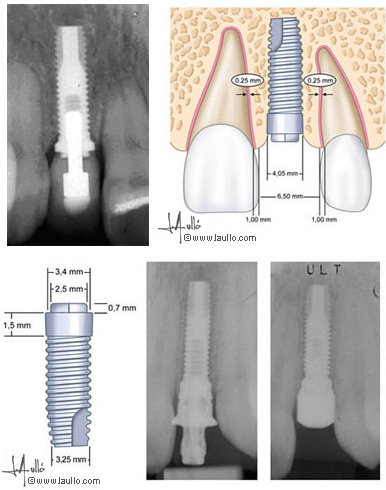 Tratamiento de implantes