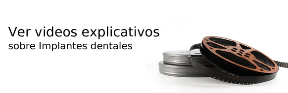 Videos explicativos sobre implantes dentales